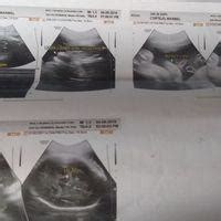 palmares ultrasound